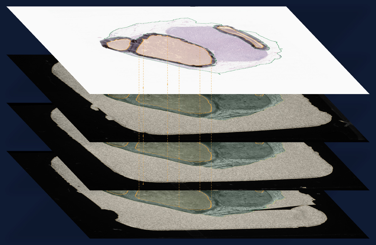 An H&E section with the pathologist's marker rings, above three unstained dissection slides of the same tissue block. The marked region, carried onto each slide by the registration, is outlined in amber.